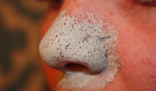 kako ukloniti mitisere sa nosa