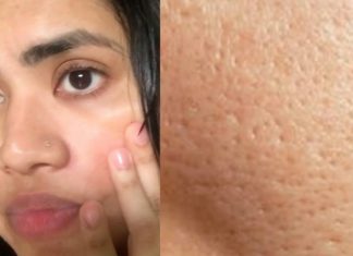 Evo kako smanjiti i zatvoriti proširene pore na licu prirodnim putem kako suziti pore
