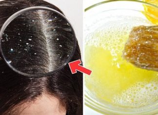 Perut u kosi: Uzroci i 11 načina pomoću kojih se može ukloniti zauvek (Evo i kako…) maska protiv peruti