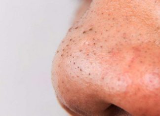 Najbolji načini za uklanjanje mitisera (parenje lica, jabukovo sirće, limunov sok…)